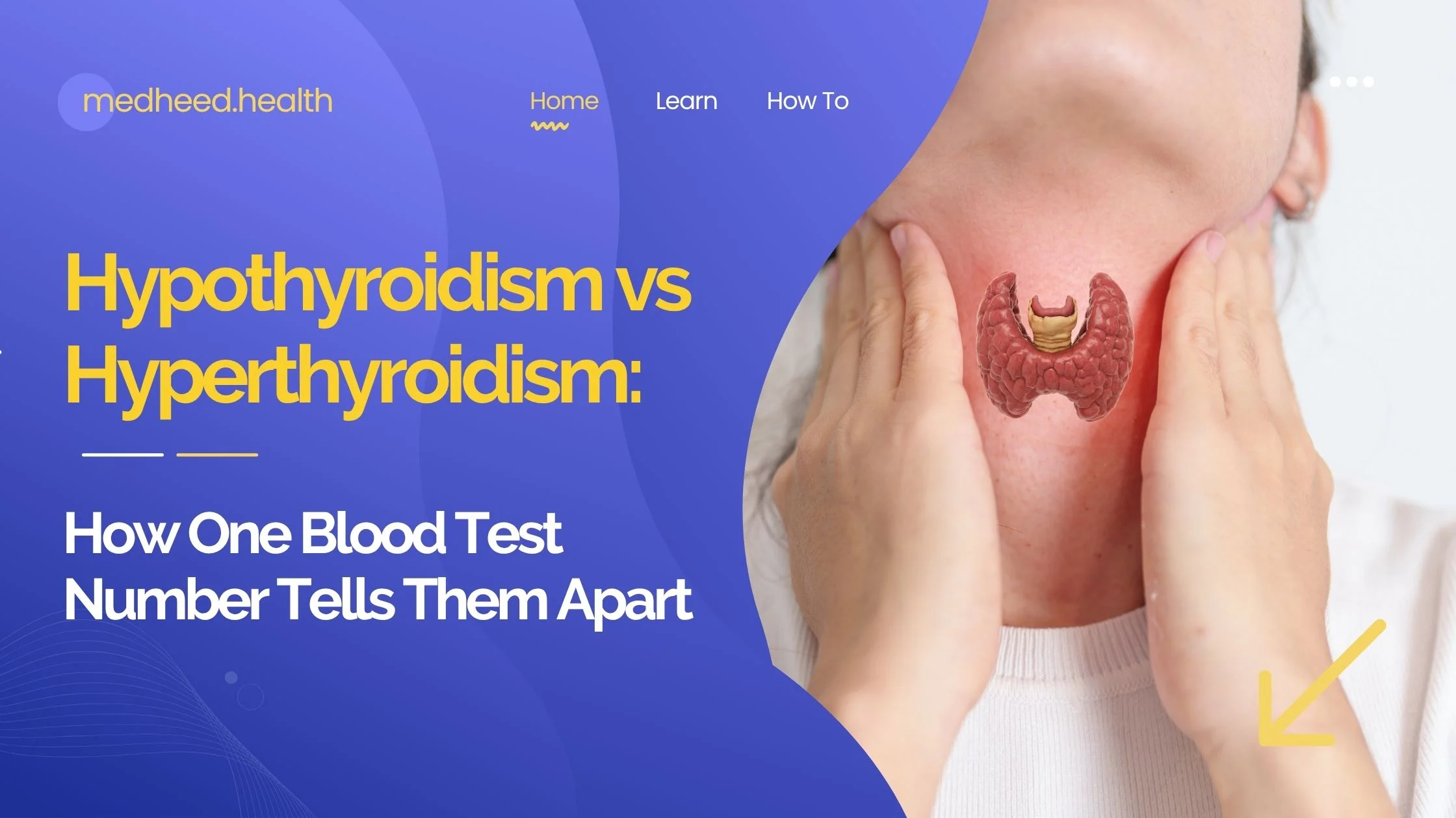 Tired or wired? Learn how one TSH number tells hypothyroidism and hyperthyroidism apart — symptoms, causes, and what to do next.